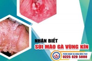 Nhận biết sùi mào gà vùng kín – Dấu hiệu có ở cả nam và nữ