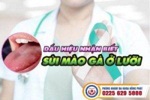 Bệnh sùi mào gà ở lưỡi không dễ dàng nhận biết