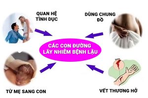 Bệnh lậu – Kẻ thù nguy hiểm đối với sức khỏe mọi người