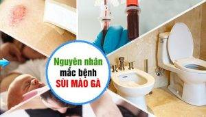 Sùi mào gà ở nam giới và những điều cần chú ý