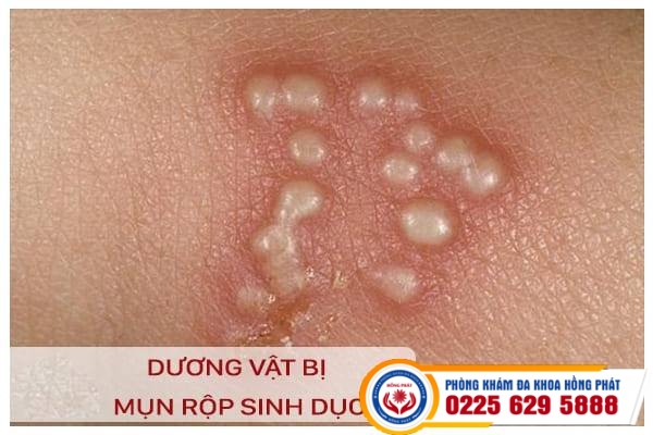 Noi-mun-o-duong-vat-co-the-la-benh-mun-rop-sinh-duc