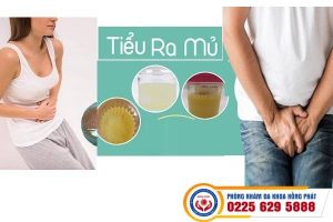 Tiểu ra mủ cần phải thăm khám ngay