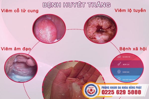 benh-huyet-trang-001