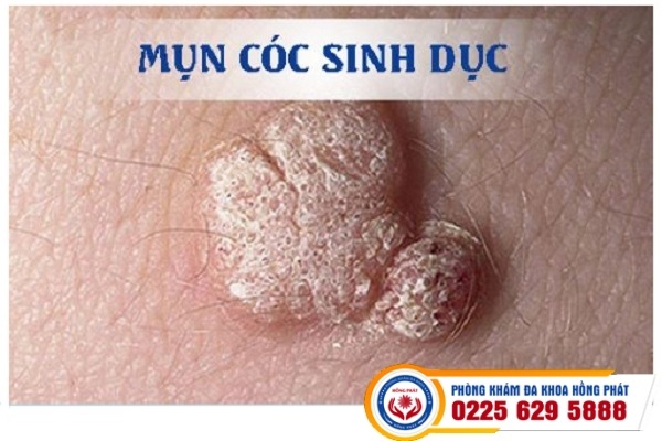 Mụn Cóc Sinh Dục Ở Nam Và Nữ Có Thể Điều Trị Tại Nhà Không