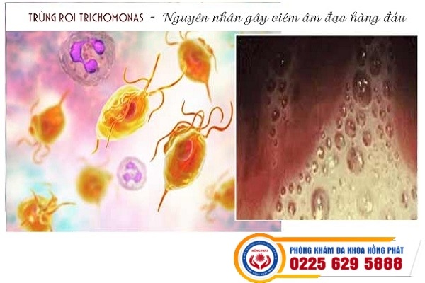 Viêm Âm Đạo Do Trùng Roi Trichomonas