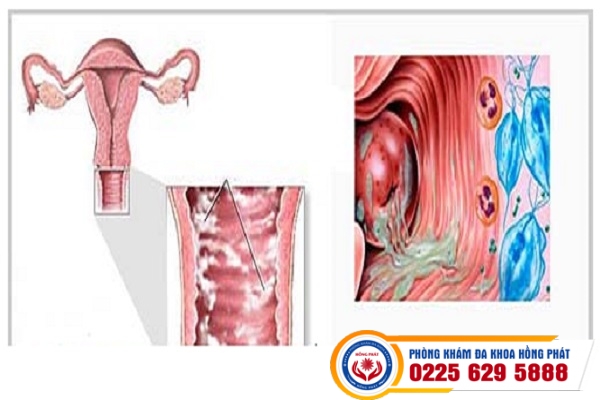 Tình Trạng Khí Hư Ra Nhiều Gây Ngứa Âm Đạo