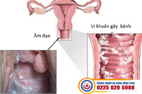 Viêm Âm Đạo – Căn Bệnh Phổ Biến Nhất Ở Phái Nữ