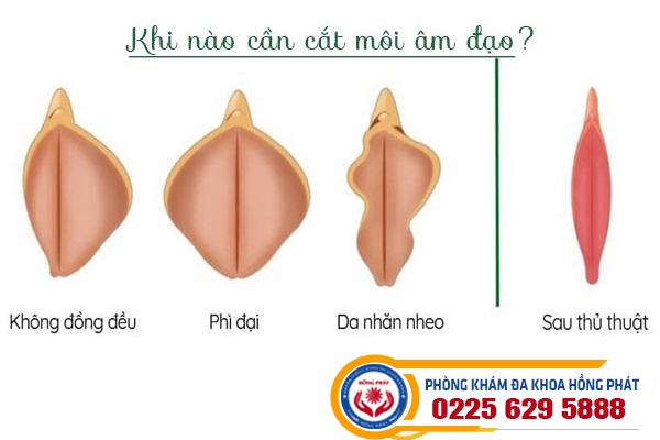 Khi Nào Cần Cắt Môi Âm Đạo? Bác Sĩ Thẩm Mỹ Phụ Khoa Đưa Ý Kiến