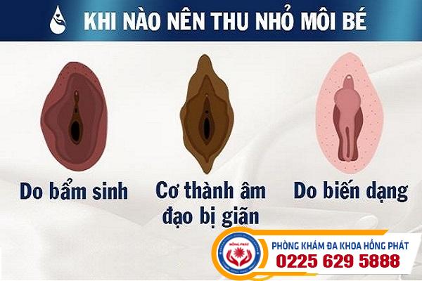 Tiểu Phẫu Cắt Mép Môi Bé Giúp Chị Em Phụ Nữ Tự Tin Hơn