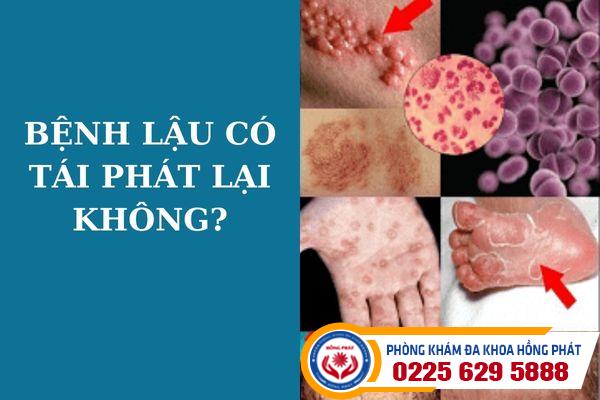 Bệnh lậu có tái phát không?