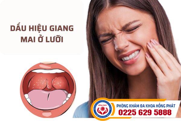 Nguyên nhân và dấu hiệu nhận biết giang mai ở lưỡi