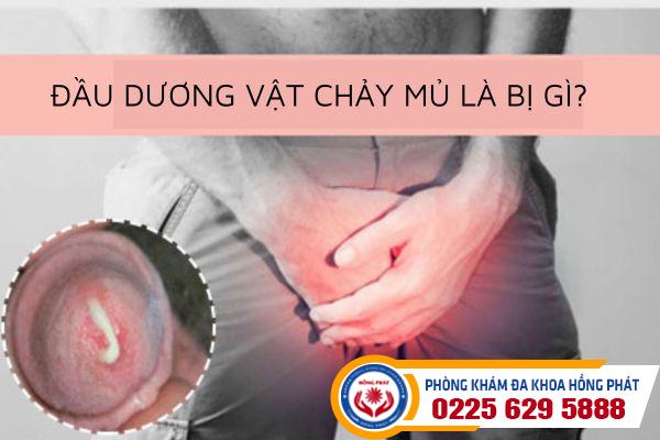 Đầu dương vật chảy mủ là bị gì?