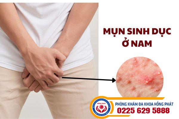 Mụn sinh dục ở nam và những ảnh hưởng nguy hiểm