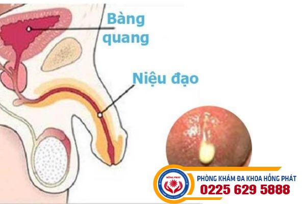 Niệu đạo chảy dịch là do đâu?