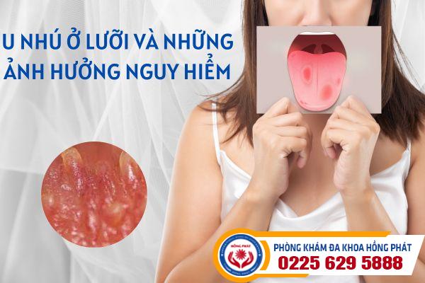 U nhú ở lưỡi và những ảnh hưởng nguy hiểm