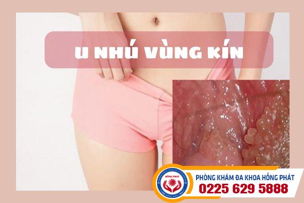 Điều trị u nhú vùng kín ở đâu hiệu quả?