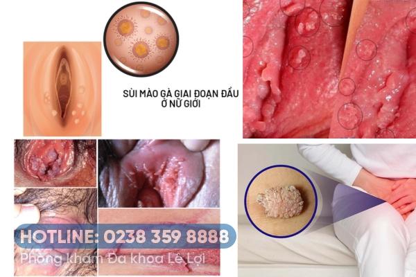 Hình ảnh giai đoạn đầu của sùi mào gà