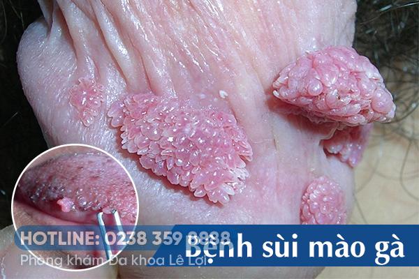 Phương pháp điều trị bệnh sùi mào gà nhanh khỏi