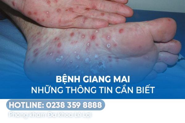 Bệnh giang mai có tự khỏi không?