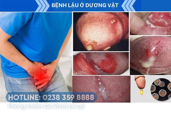 Triệu chứng bệnh lậu ở dương vật giai đoạn đầu