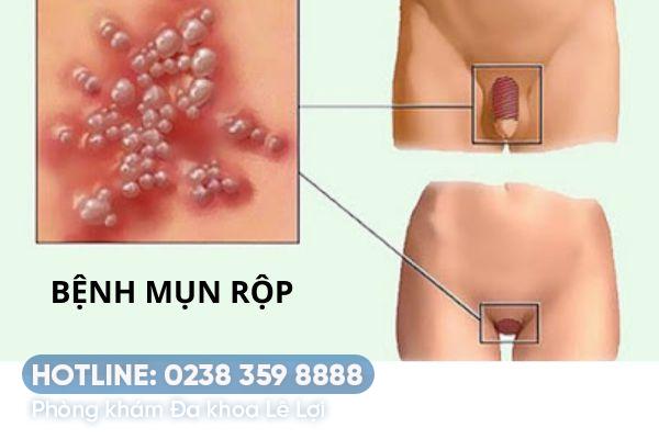 Bệnh mụn rộp có tự khỏi bệnh không?