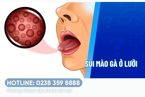 Sùi mào gà ở lưỡi giai đoạn đầu có biểu hiện gì?