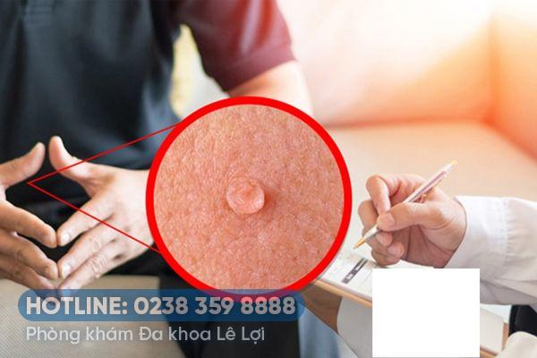 Dấu hiệu mụn cóc sinh dục ở nam và nữ