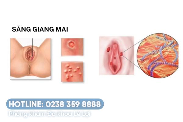 Giai đoạn đầu bệnh giang mai ở nữ có biểu hiện gì?