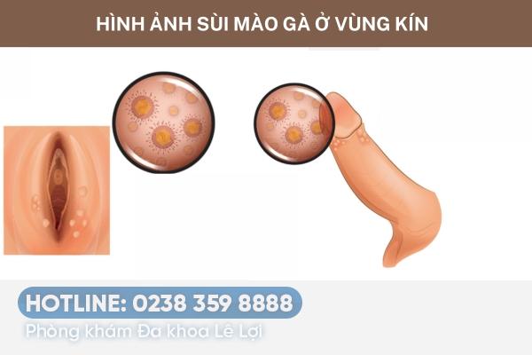 Hình ảnh sùi mào gà ở vùng kín