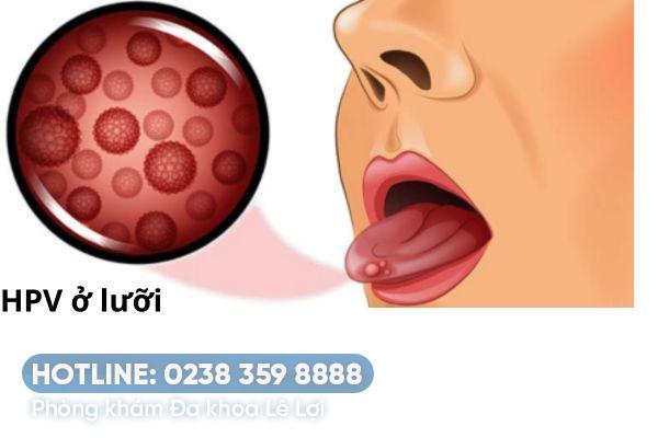 Biểu hiện HPV ở lưỡi thường gặp