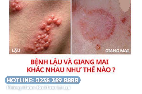 Biểu hiện bệnh lậu và giang mai ở nữ