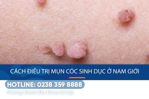 Phương pháp trị mụn cóc dương vật hiệu quả cao