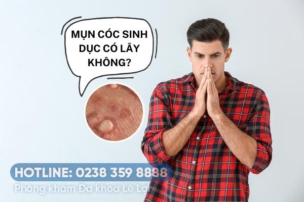 Mụn cóc sinh dục có lây không?