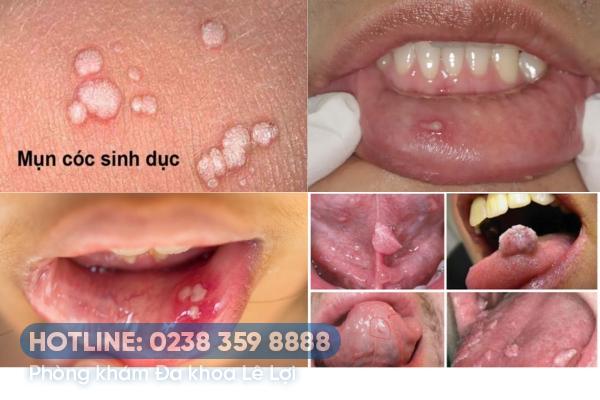 Mụn cóc sinh dục ở miệng nguyên nhân dấu hiệu và cách chữa