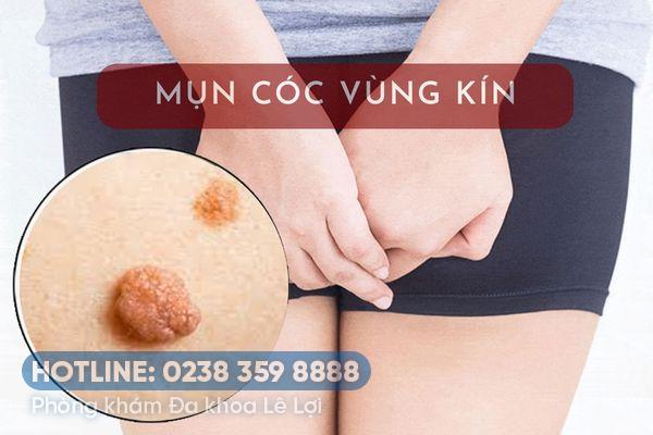 Cách chữa mụn cóc vùng kín