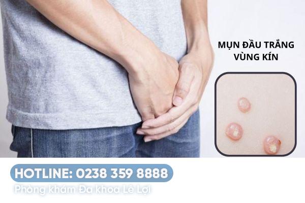 Mụn đầu trắng ở vùng kín nam có phải là dấu hiệu bệnh?