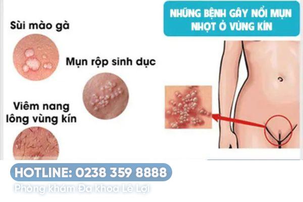 Cách chữa trị mụn nhọt vùng kín nam