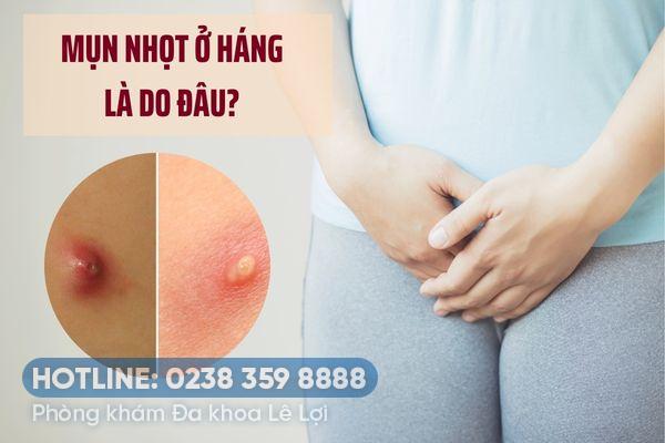 Nguyên nhân nổi mụn nhọt ở háng và cách điều trị