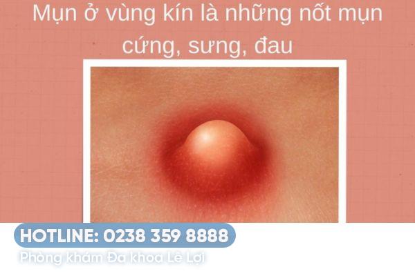 Nổi mụn trắng ở nữ: Dấu hiệu bệnh lý