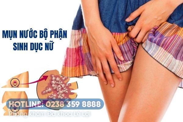 Mụn nước bộ phận sinh dục nữ – Dấu hiệu bệnh lý nguy hiểm