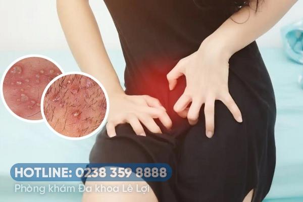 Mụn nước ở môi lớn & bé nguyên nhân và cách điều trị