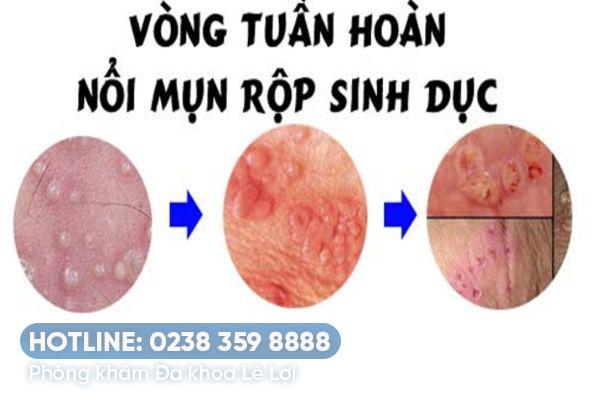 Mụn rộp lây qua con đường nào?