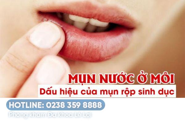 Chữa mụn nước ở môi như thế nào?