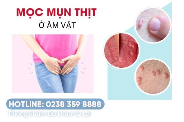 Mụn thịt âm vật là bị bệnh gì điều trị ra sao?