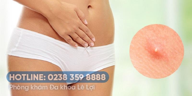 Mụn cơm hoa liễu là bệnh gì?