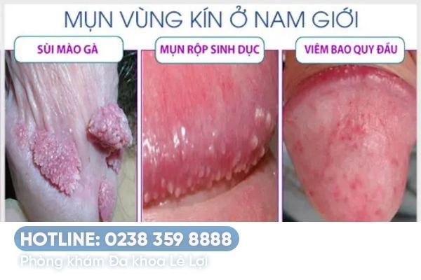 Cách trị mụn vùng kín nam hiệu quả