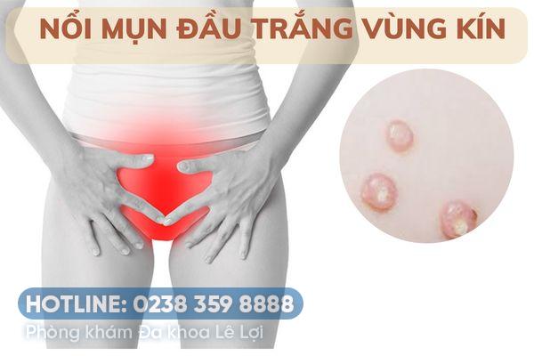 Nổi mụn đầu trắng vùng kín là bị bệnh gì?