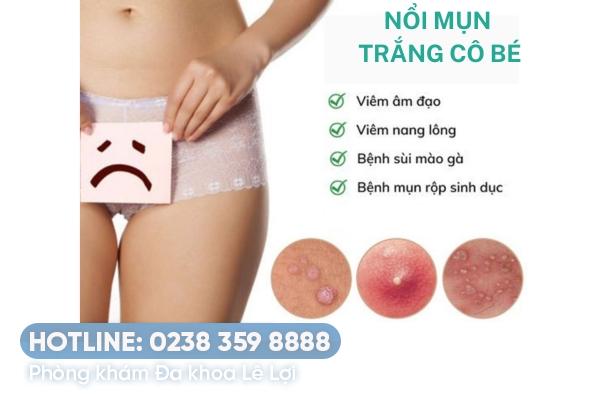 Nguyên nhân và cách điều trị mụn trắng ở cô bé