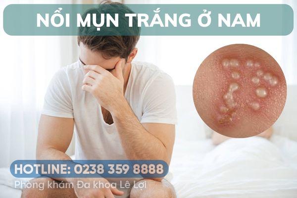 Mụn trắng ở vùng kín nam là bị gì?