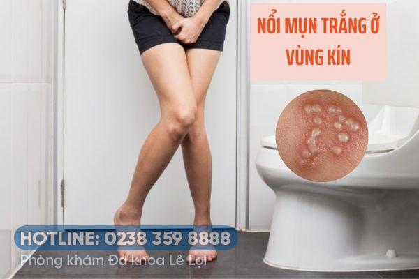 Nổi mụn trắng ở vùng kín là bị bệnh gì?